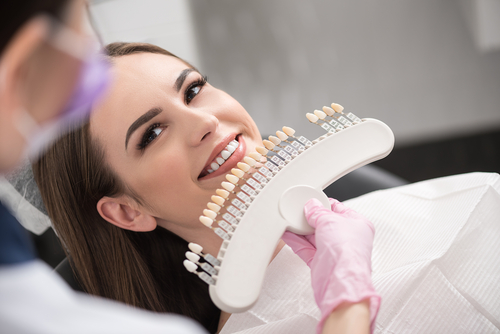 dental veneers